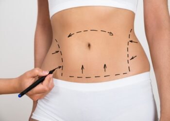Liposuction Uses, What to Expect and Risks