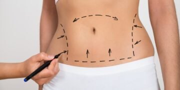 Liposuction Uses, What to Expect and Risks