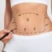 Liposuction Uses, What to Expect and Risks